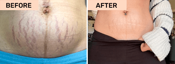 b flat stretch marks