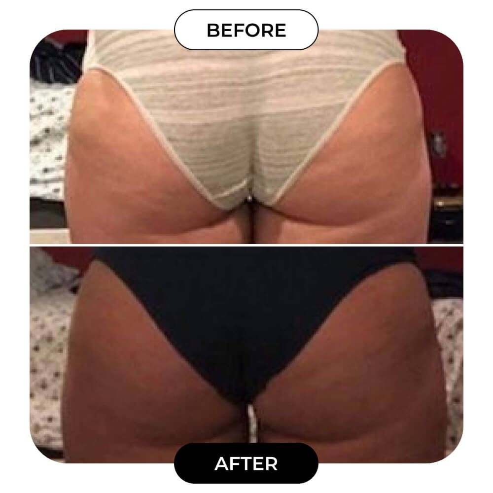 MAËLYS Cosmetics B-TIGHT Leave-On Butt Mask - Helps Reduce The Appearance  Of Cellulite