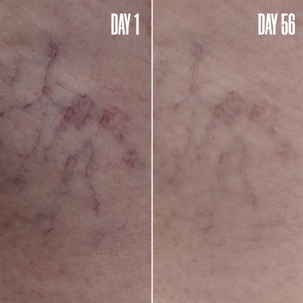 B-VAIN Vein Blurring Serum