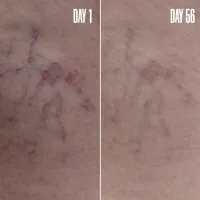 BLUR ‘N’ SMOOTH The Wrinkle & Vein Duo 