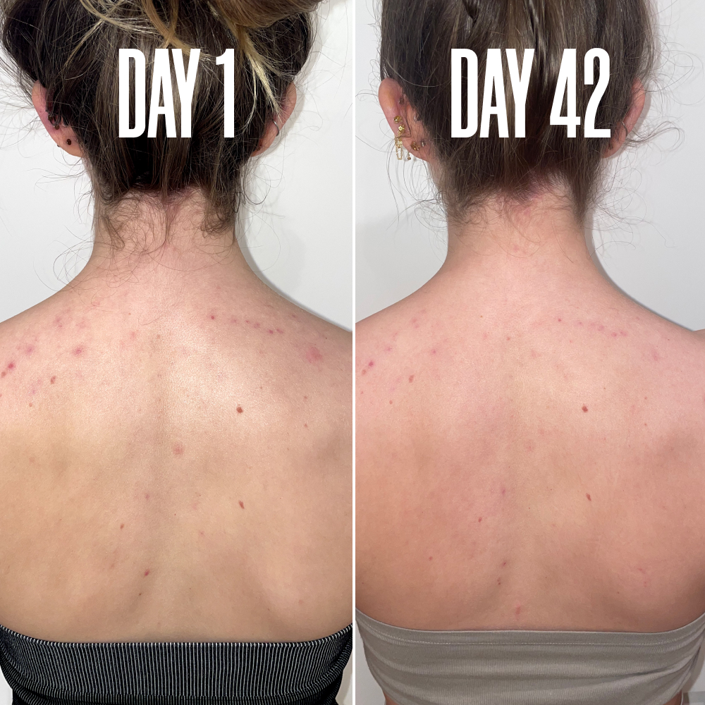 GETBACK Targeted Body Acne Spray MAЁLYS®