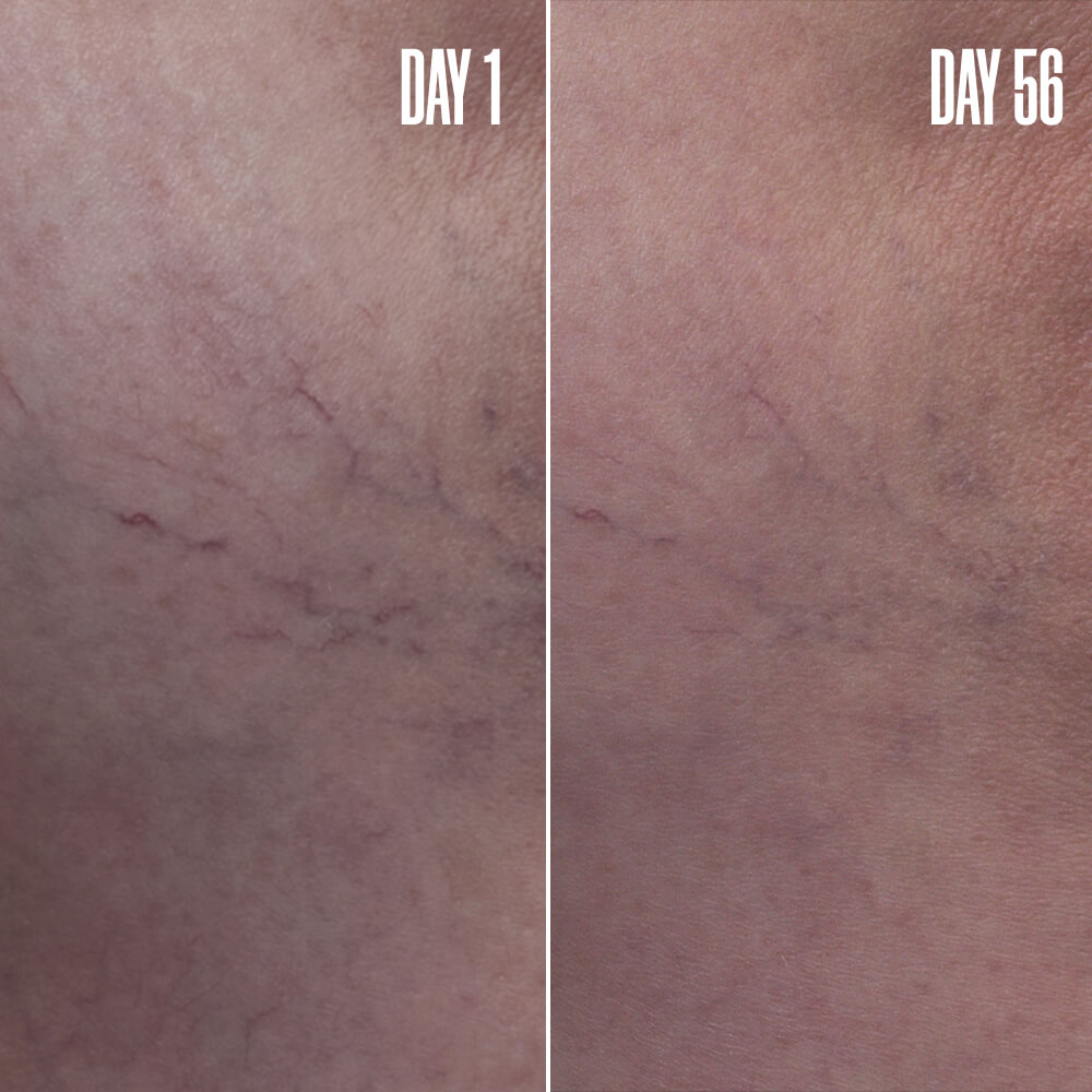 B-VAIN Vein Blurring Serum