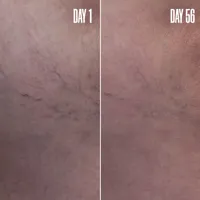 BLUR ‘N’ SMOOTH The Wrinkle & Vein Duo 