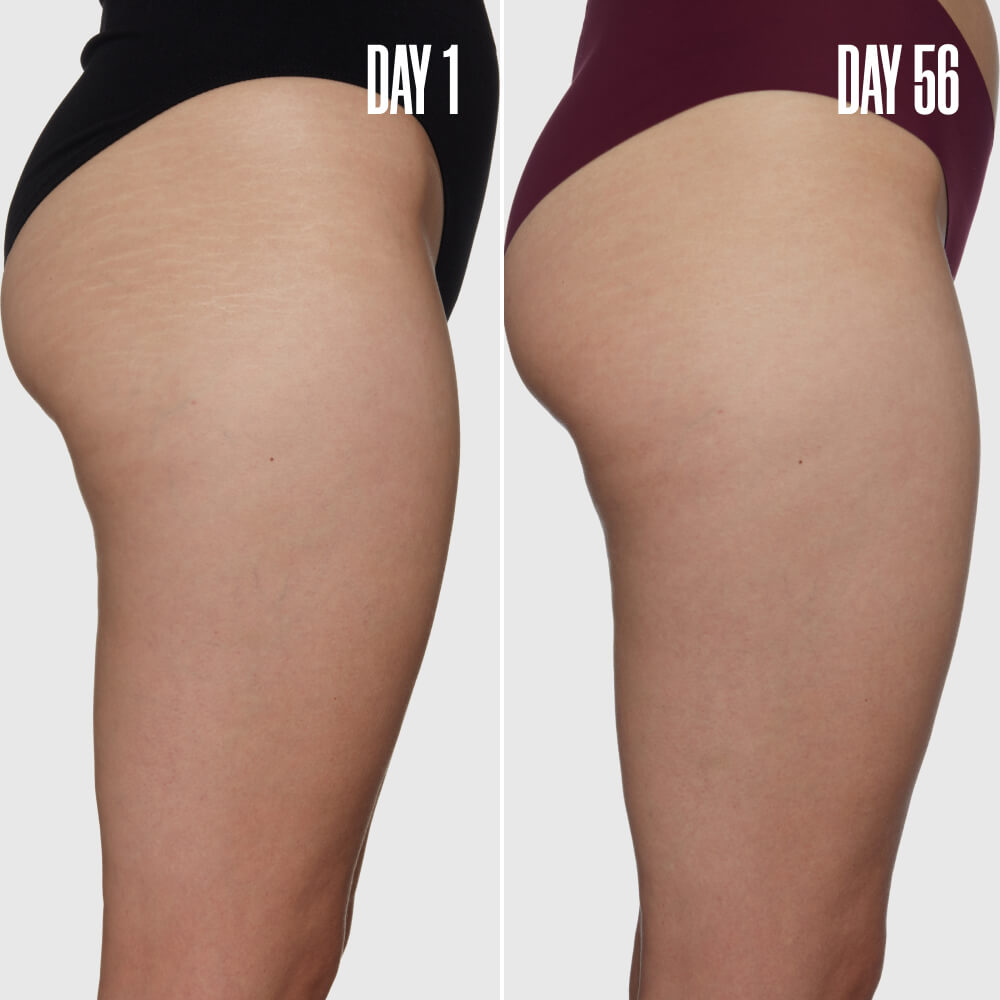 B-SLEEK Outer Thigh Stretch Mark Cream
