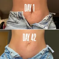 HOLD ON TIGHT The Stretch Mark & Cellulite Bundle