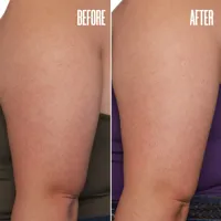 GET-LEVEL Keratosis Pilaris Body Scrub